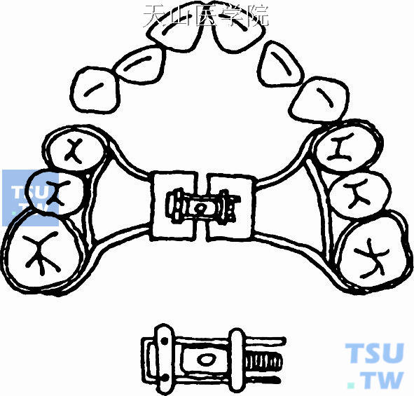 口腔正畸常用器械图解图片