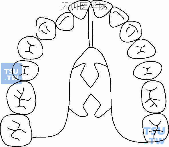 上颌分裂基托矫治器