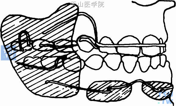 功能调节器侧面观