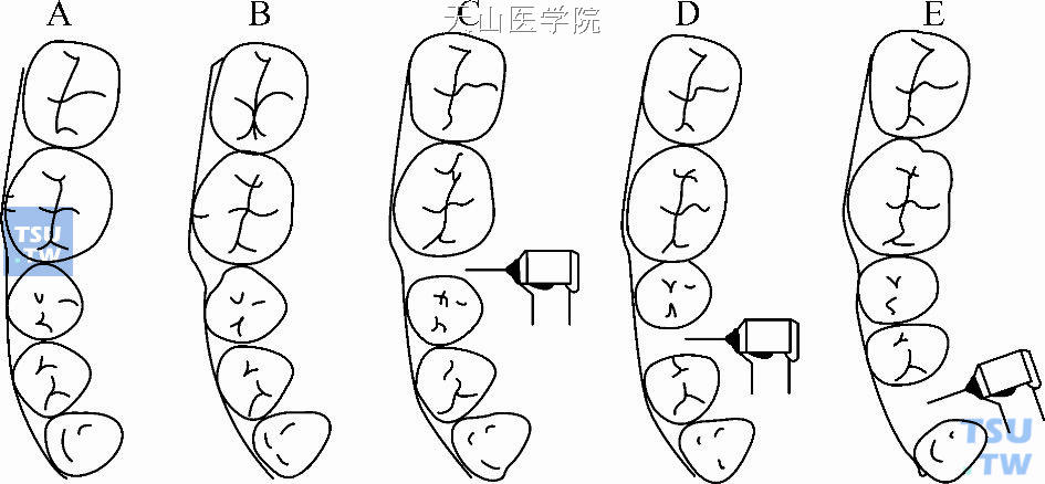 邻面去釉