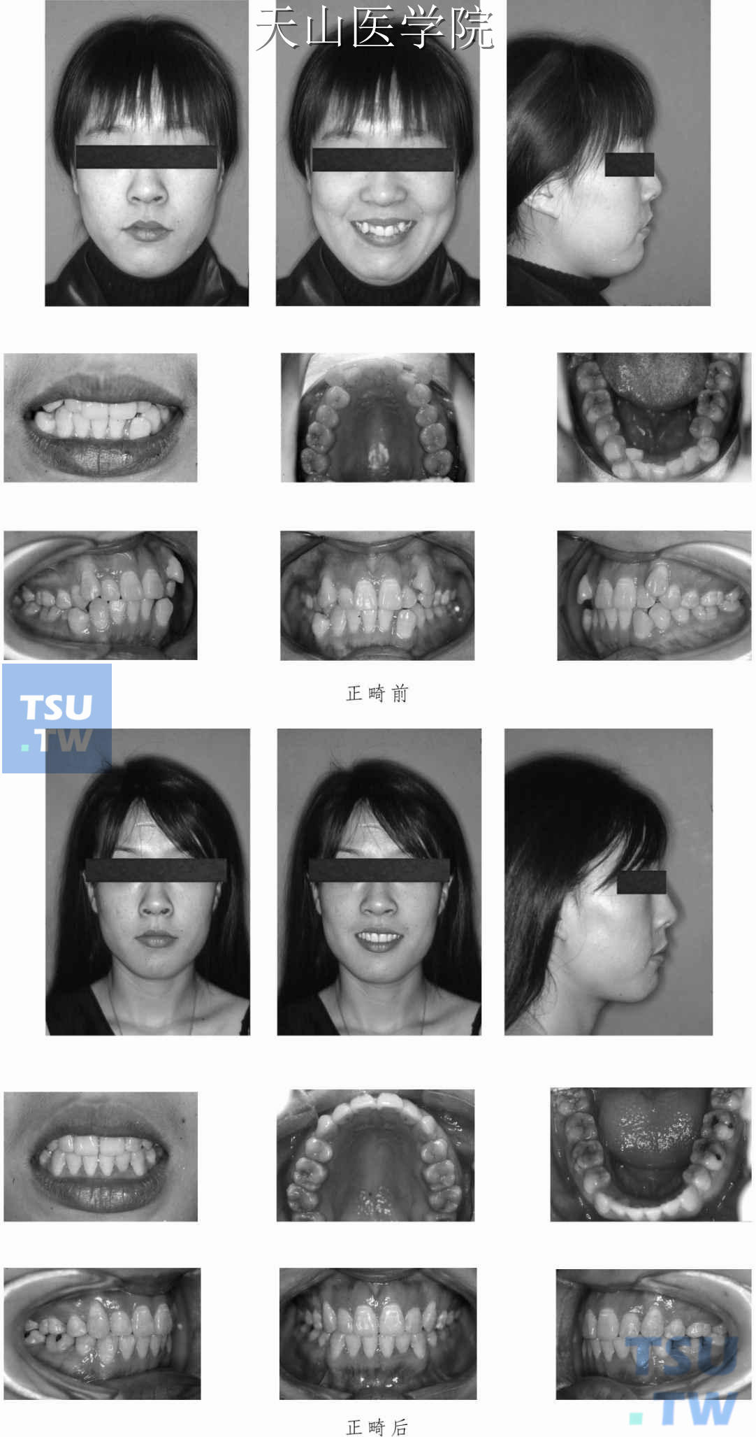 牙列拥挤正畸治疗病例