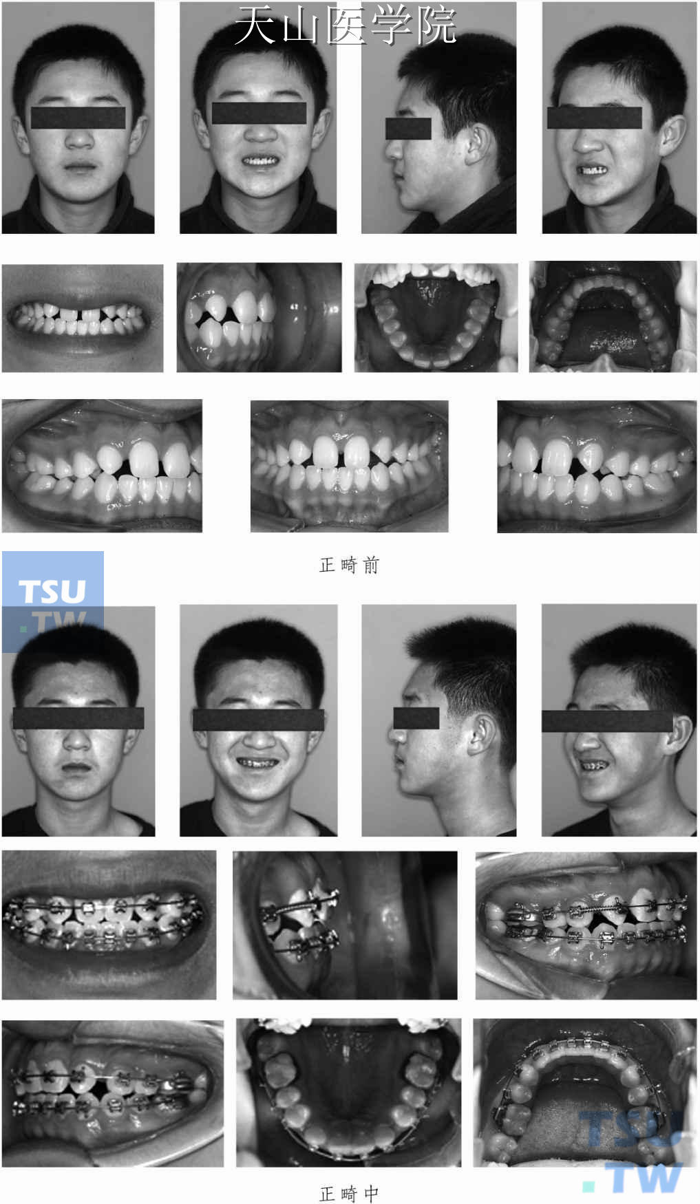 牙列散在间隙正畸治疗病例