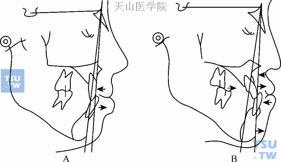 牙矢状方向不调的正畸矫正