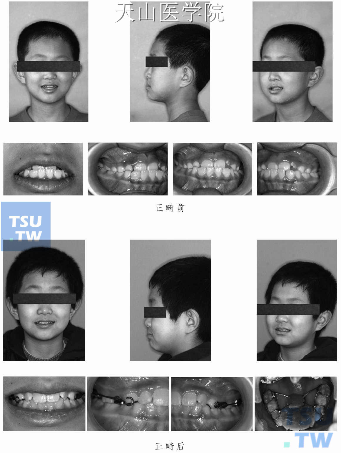 前牙反牙合治疗病例