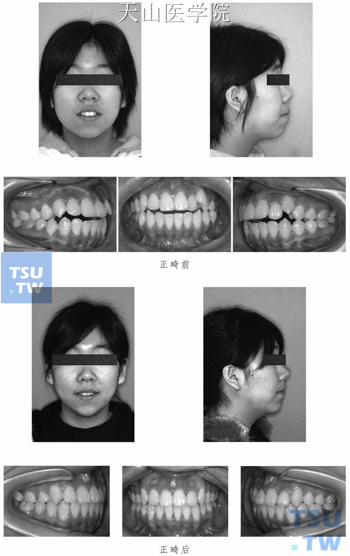 双牙合前突正畸治疗病例