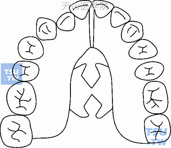 上颌分裂基托矫治器
