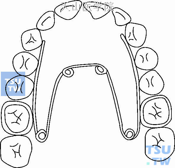 上颌后牙牙合垫扩弓器