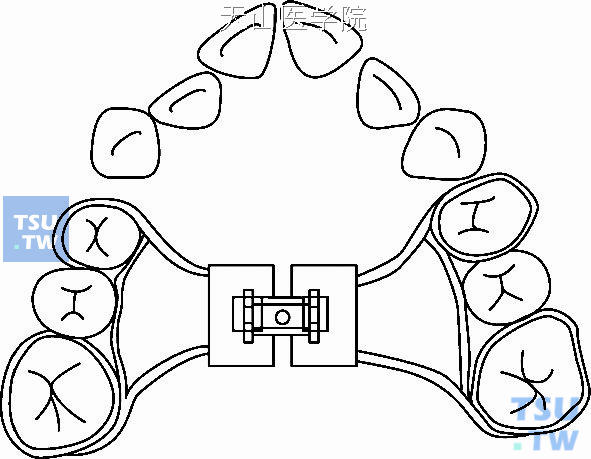 口腔正畸常用器械图解图片