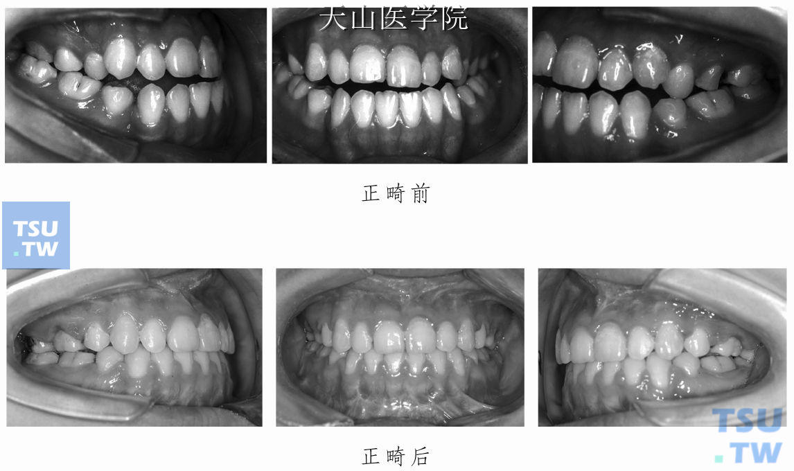 后牙反牙合正畸前后的对比照片