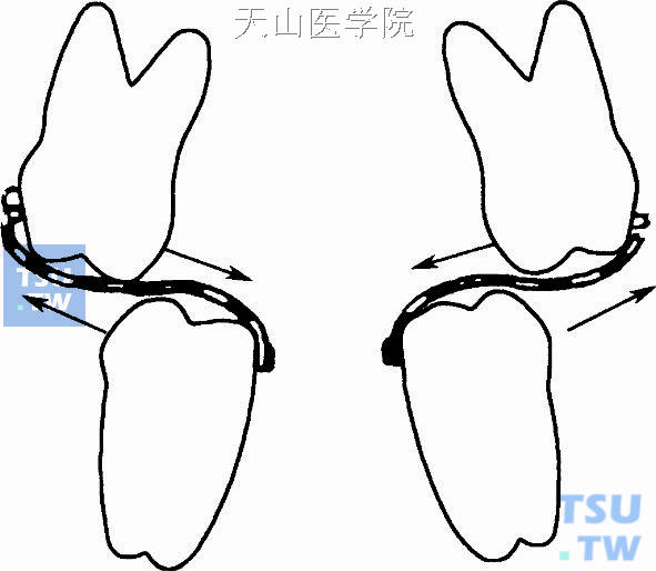 正畸一类牵引示意图图片