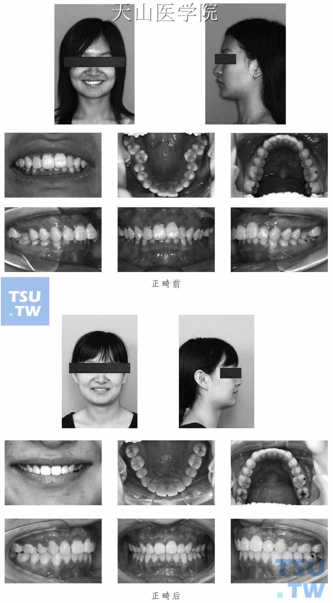 后牙锁牙合正畸治疗病例