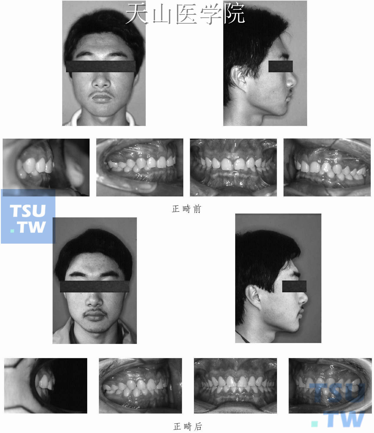 深覆牙合治疗病例