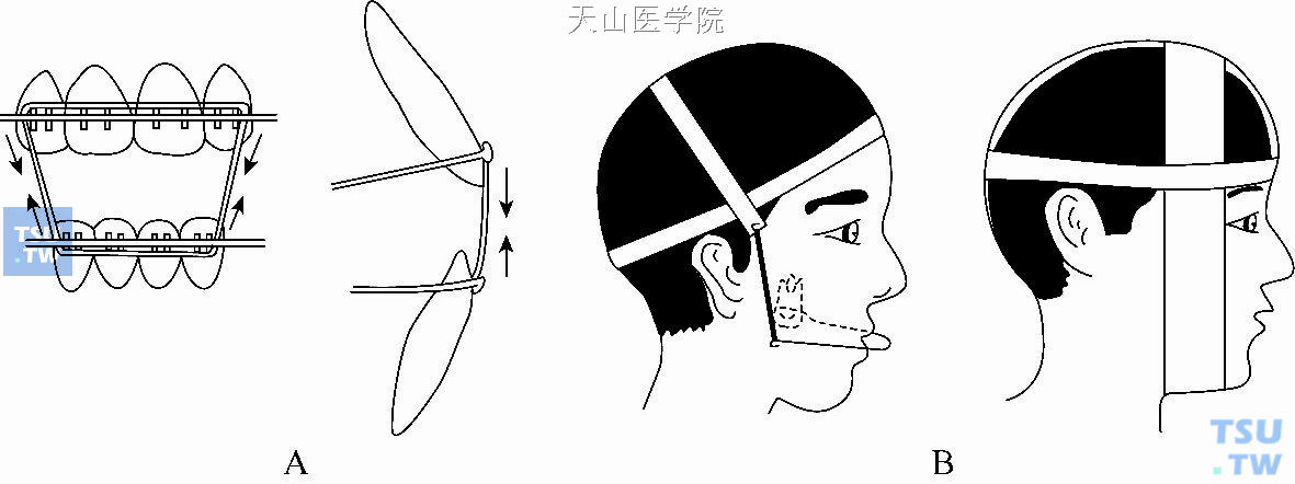 A. 垂直向牵引；B. 口外弓垂直牵引压低后牙