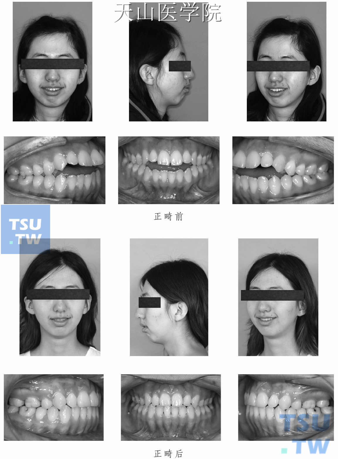 开牙合畸形治疗病例