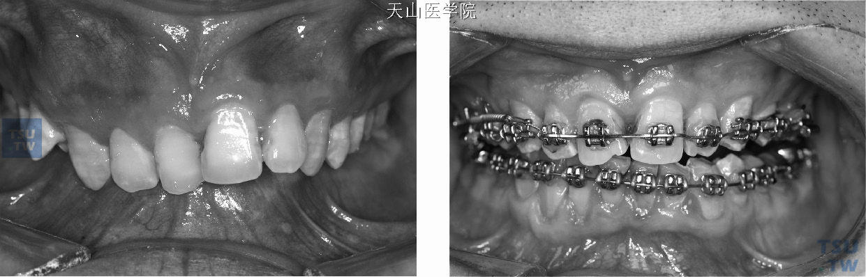 前牙闭锁性深覆牙合，治疗中覆牙合变浅，上切牙舌倾改善