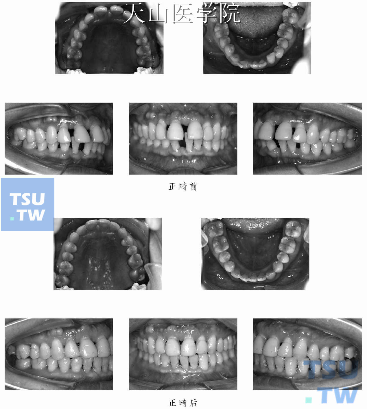 牙周病正畸后牙周情况改善