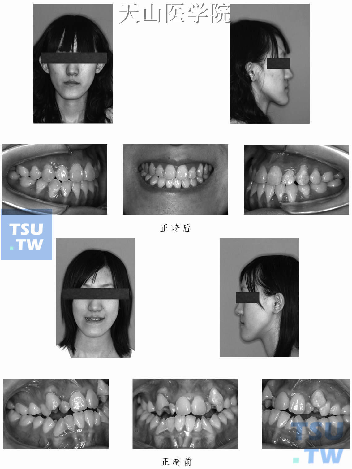 成人骨性畸形掩饰性正畸治疗病例