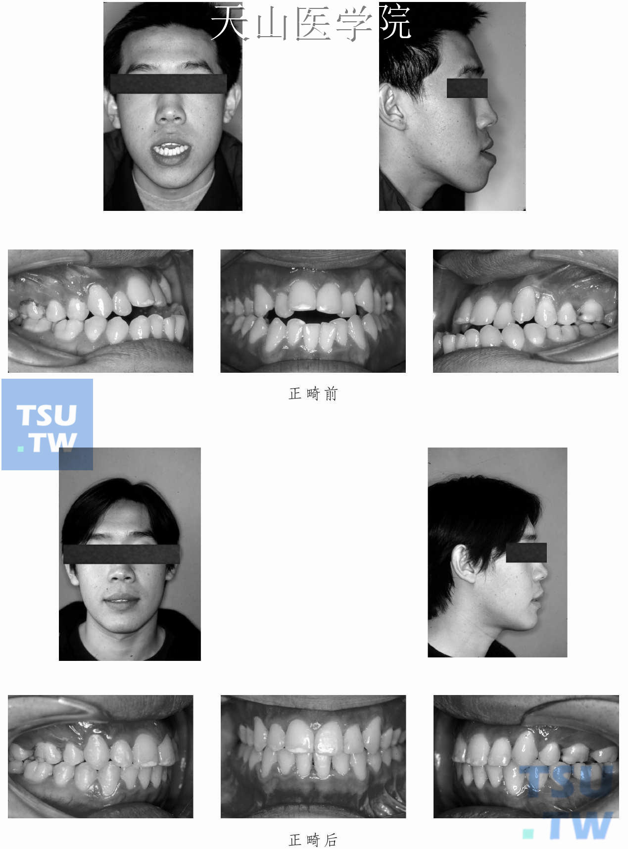 成人正畸正颌病例