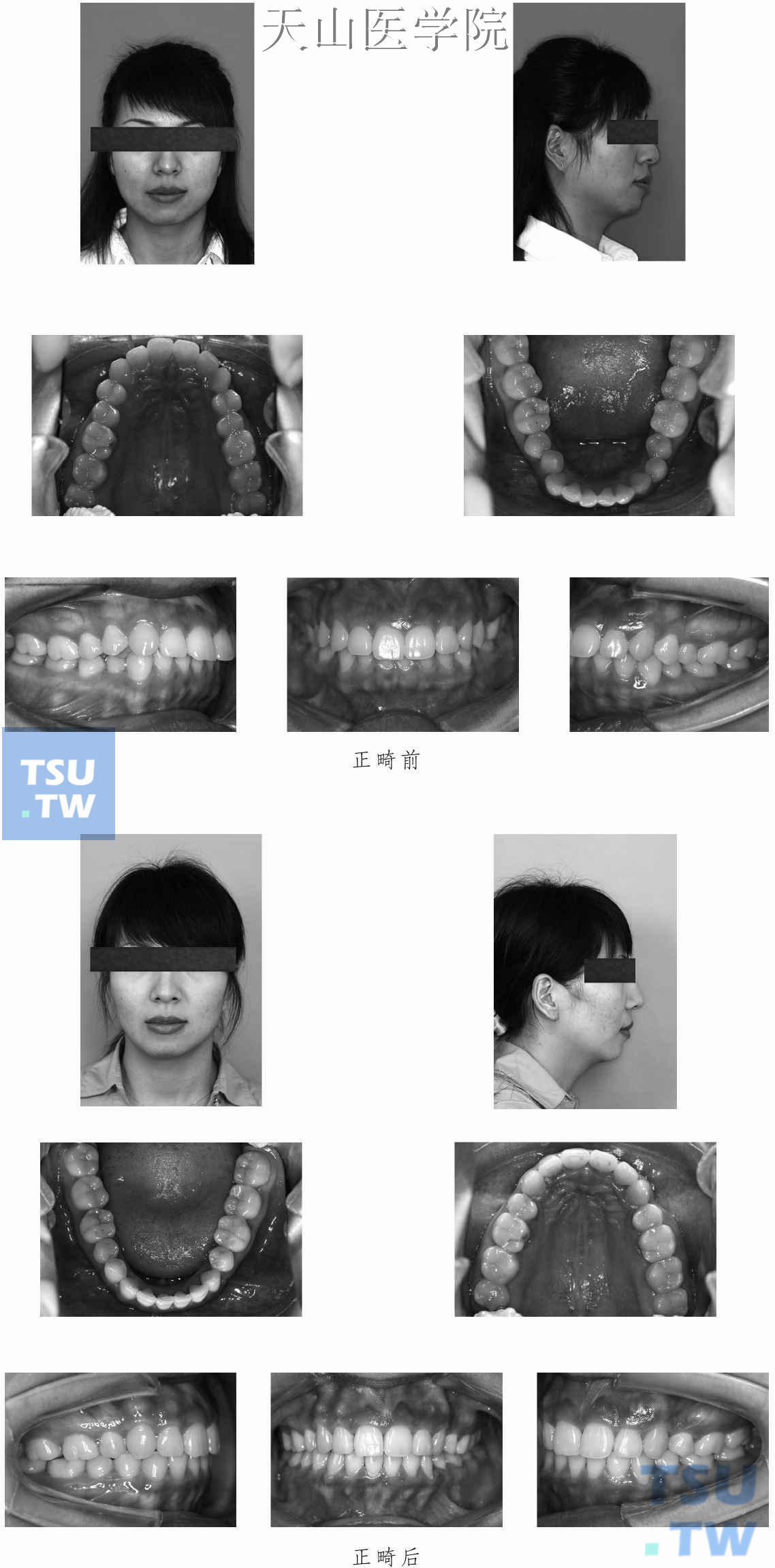 舌侧正畸病例