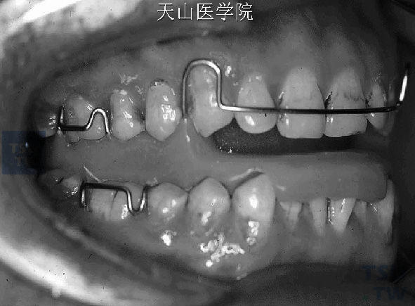 口腔矫治器治疗鼾症和阻塞性睡眠呼吸暂停低通气综合征