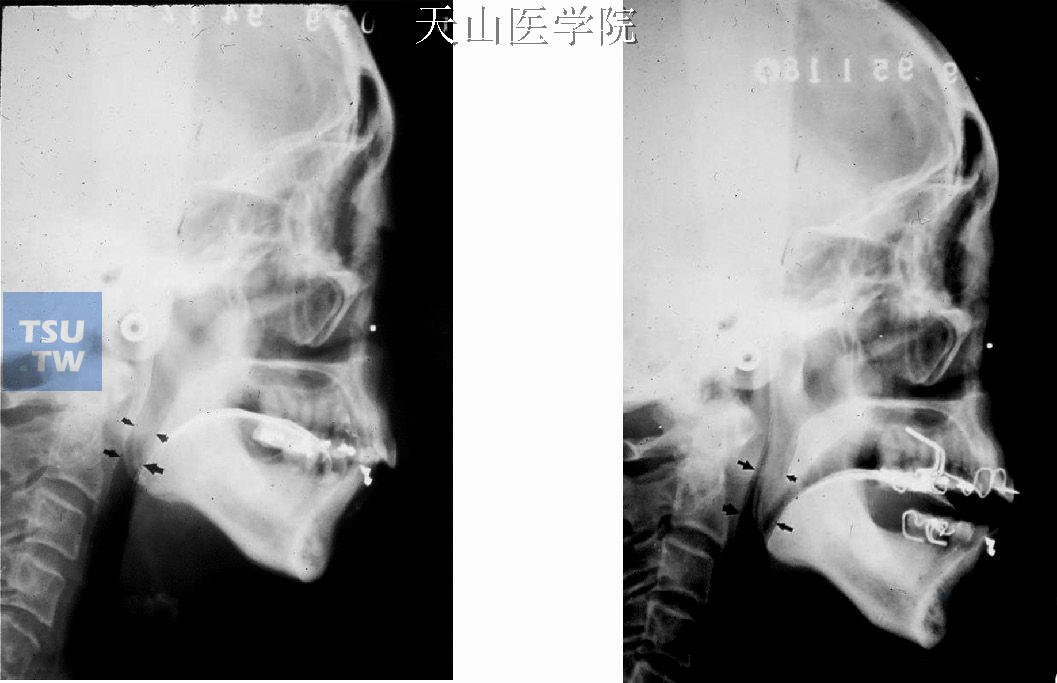 头影侧位片分析戴下颌前移器后上气道的变化
