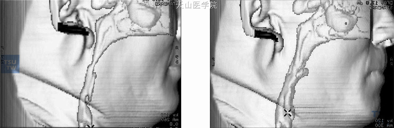 CT分析戴入矫治器前后上气道的变化