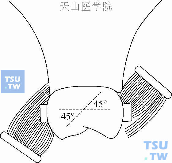 戴有固定矫治器的刷牙方向