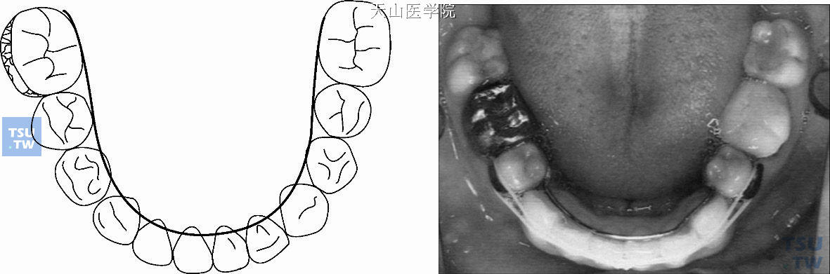 固定舌弓保持器