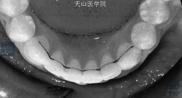 粘固式前牙舌侧固定保持器