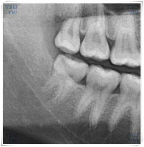 智齿正常萌出的下颌智齿X线表现
