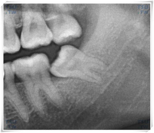  近中阻生的下颌智齿X线表现