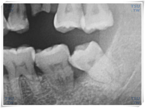 智齿发育萌出过程中角度的变化及牙根形态改变