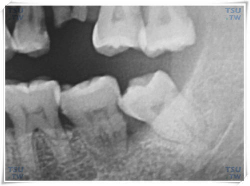  近中阻生的下颌智齿X线表现