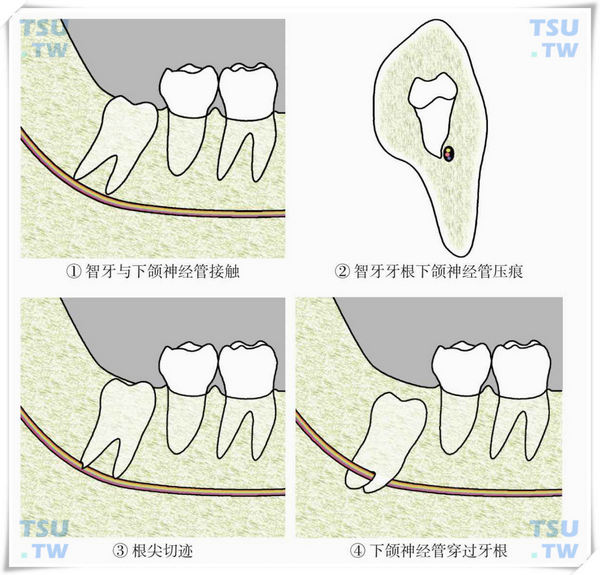 下颌智齿的应用解剖