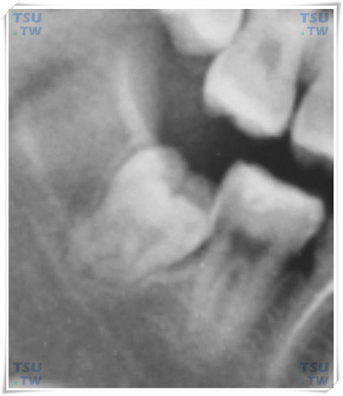 智齿与周围颌骨的关系