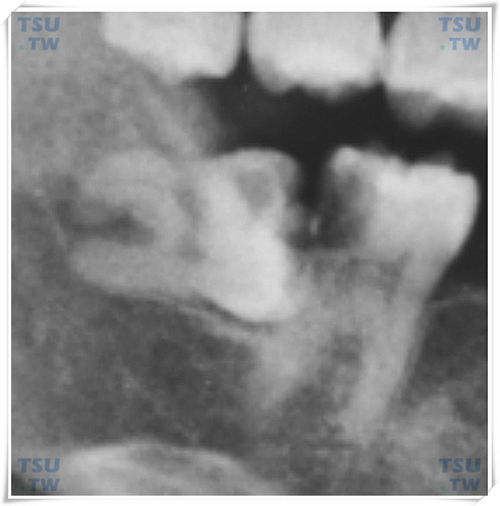  智齿导致第二磨牙远中牙槽间隔吸收