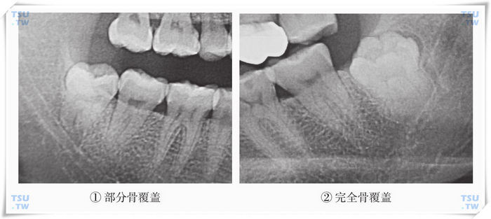  智齿冠侧组织