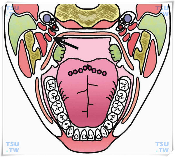 智齿与颌面间隙：咬肌、颊、翼颌、咽旁、下颌下间隙