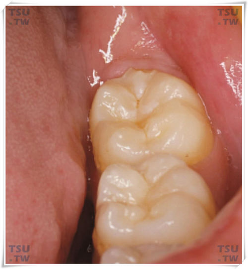  磨牙牙冠牙合面
