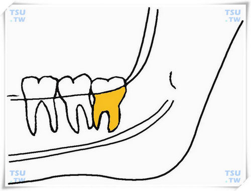  下颌高位垂直阻生智齿