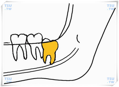  下颌中位垂直阻生智齿