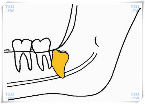  下颌低位垂直阻生智齿
