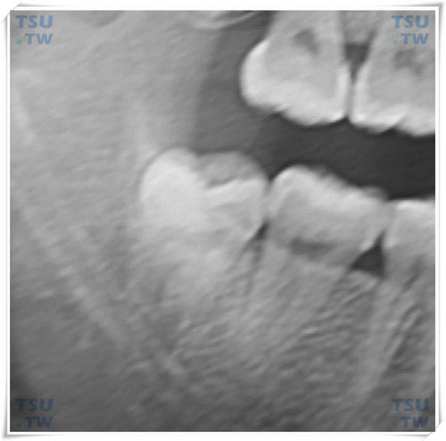  下颌高位垂直阻生智齿
