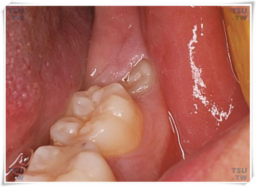 下颌中位垂直阻生智齿