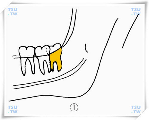  下颌高位垂直颊侧阻生智齿