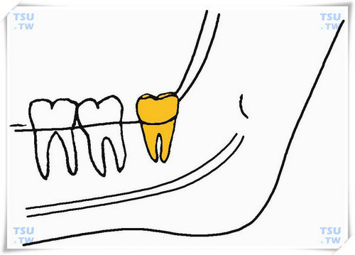  下颌间中高位垂直阻生智齿