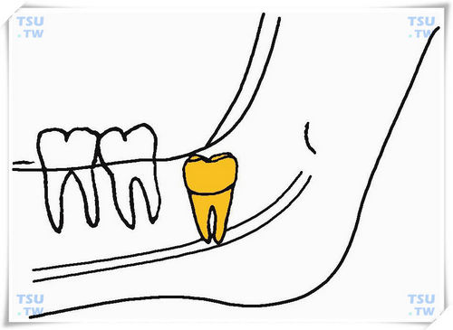  下颌间中垂直中位阻生智齿