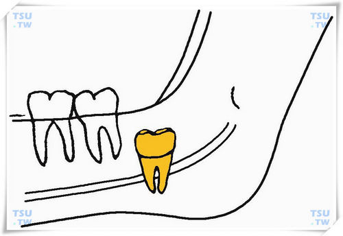 下颌间中垂直低位阻生智齿