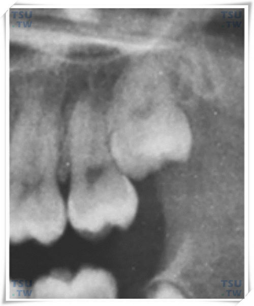  上颌中位垂直阻生智齿