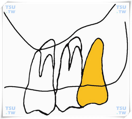  上颌垂直腭侧阻生智齿